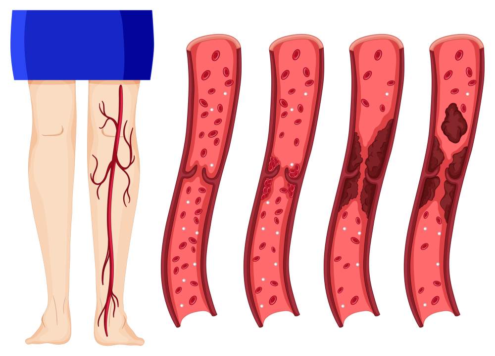 Deep Vein Thrombosis – A medical condition that requires deep consideration