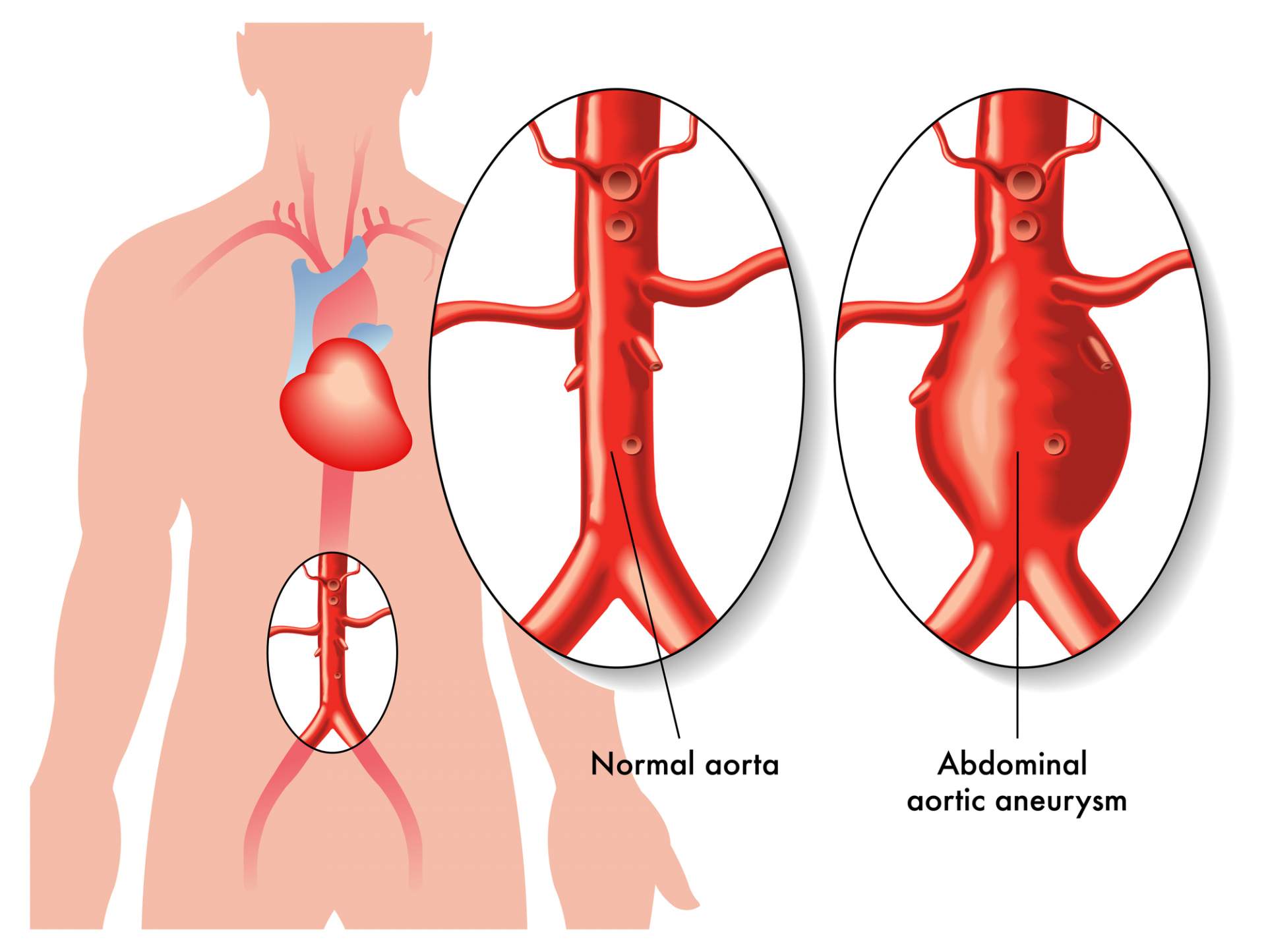 Abdominal Aortic Aneurysm